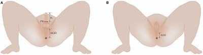 Reference Values for and Correlation Analysis of the Anogenital Distance of Chinese Han Full-Term Singleton Neonates